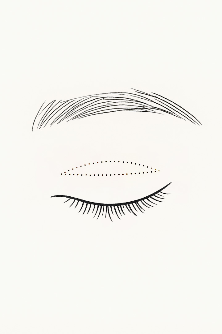 Non Incision Step 01