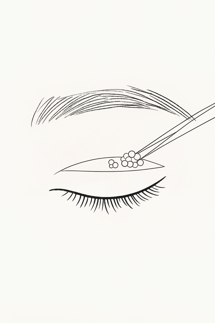 Non Incision Step 02