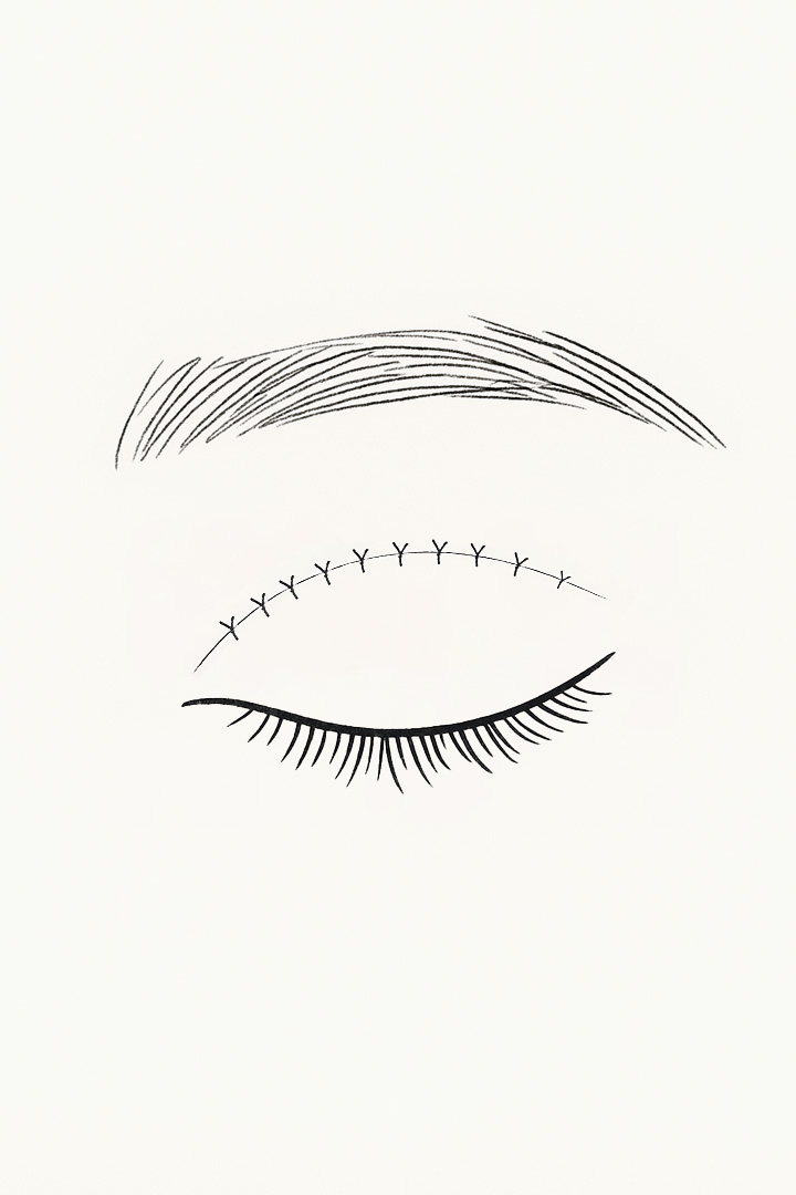 Non Incision Step 03