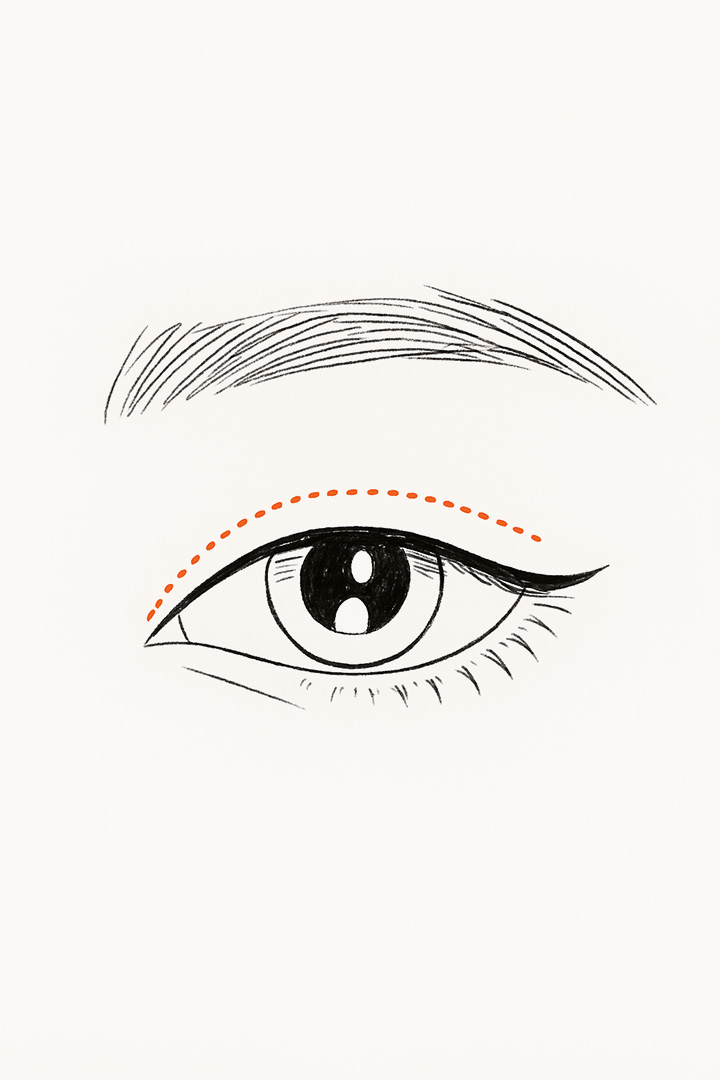 Non Incision Step 01