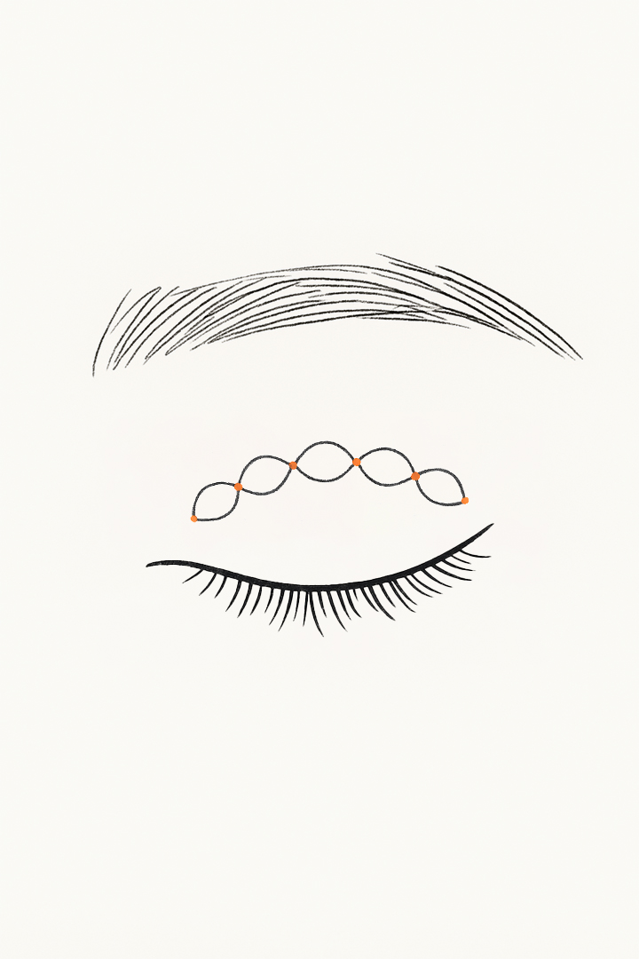 Non Incision Step 03