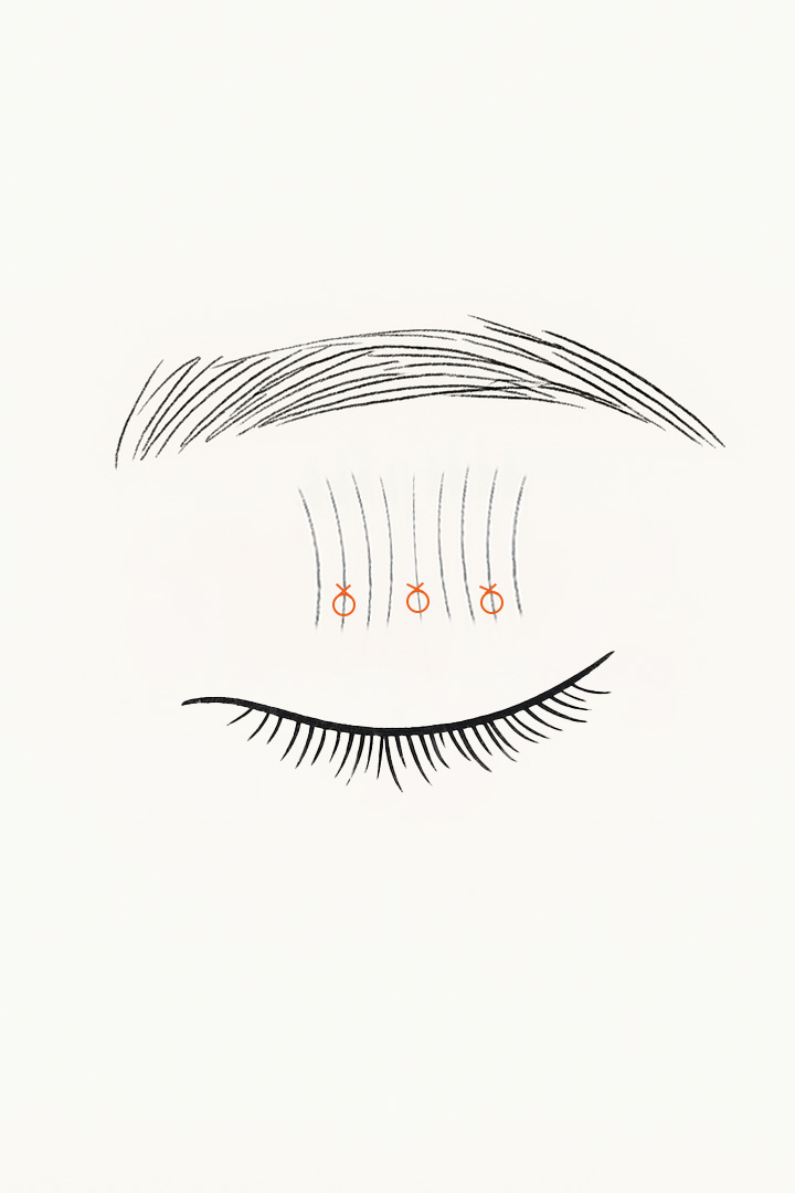 비절개 눈매교정 과정 03