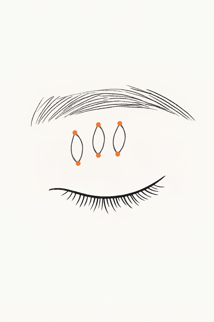 비절개 눈매교정 과정 03