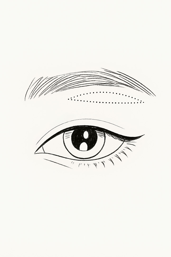 Midage Upper Eyelid Surgery 01