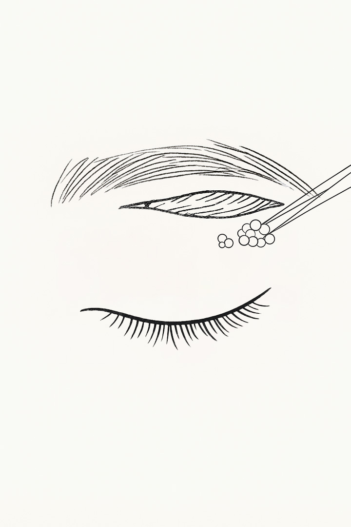 Midage Upper Eyelid Surgery 02