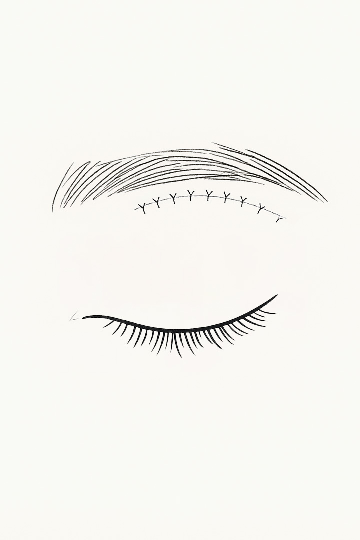 Midage Upper Eyelid Surgery 03