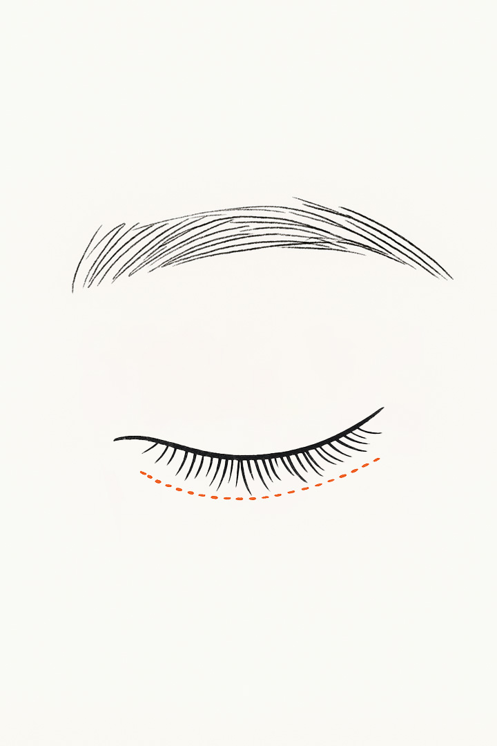 Midage Upper Eyelid Surgery 01