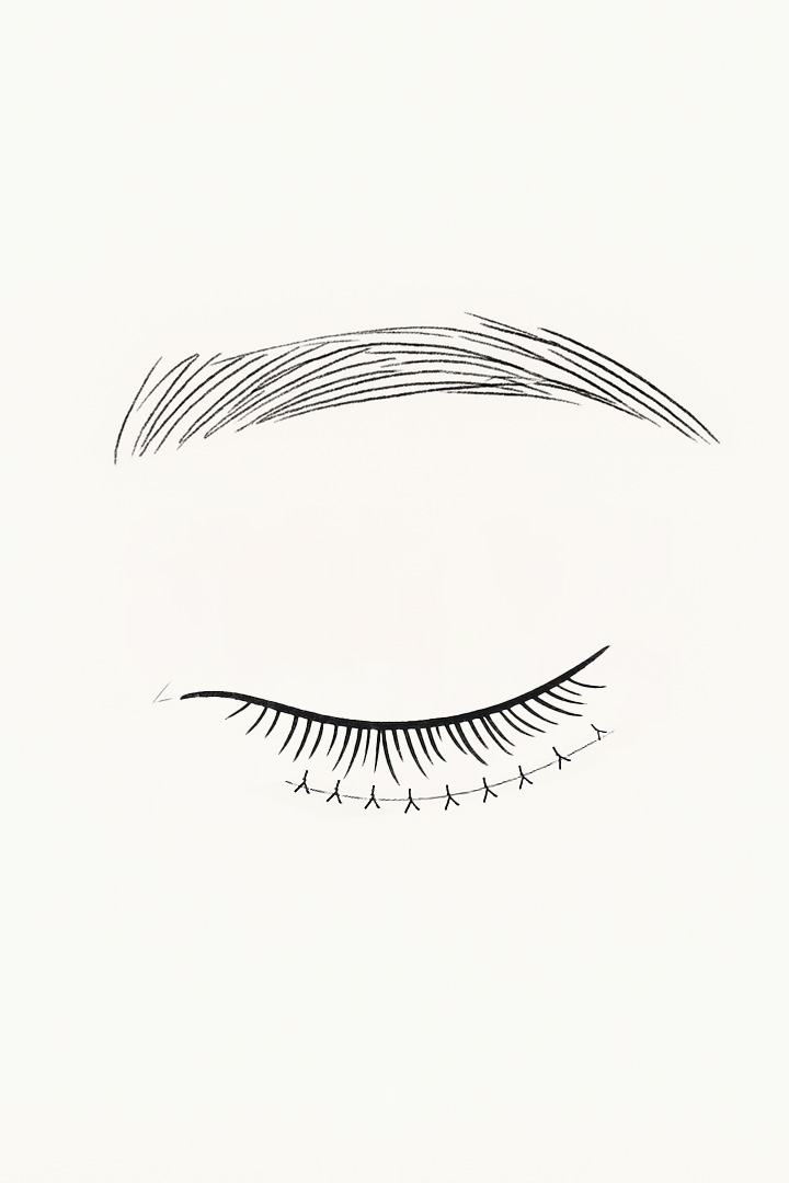 Midage Upper Eyelid Surgery 03