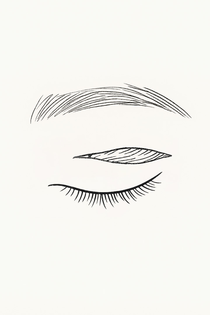 Midage Upper Eyelid Surgery 01