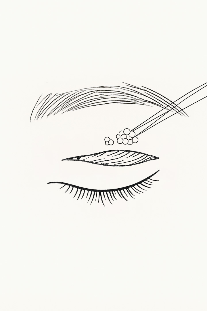 Midage Upper Eyelid Surgery 02