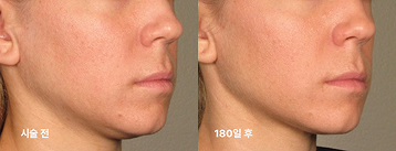 울쎄라 Before after 01