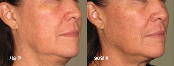 울쎄라 Before after 02