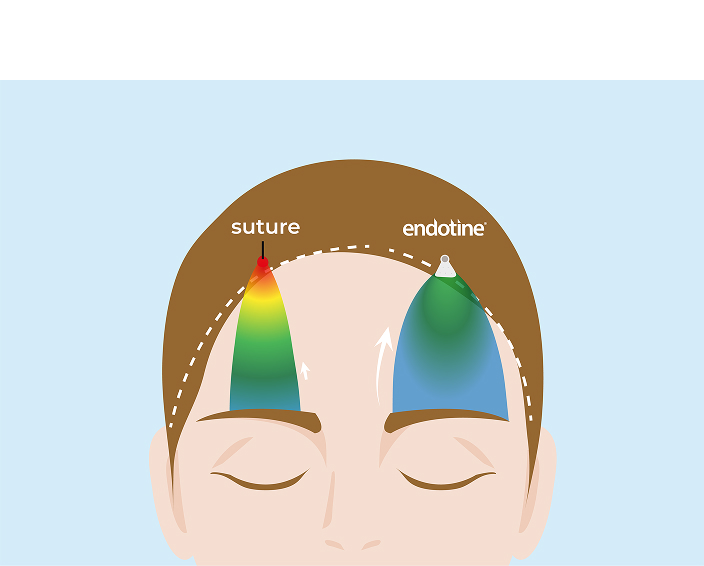 다중 고정 타인