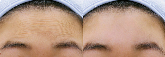 깊은 가로 주름 개선