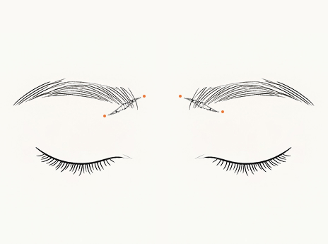 개개인의 얼굴 형태에 따라 추미근을 절제합니다.[b] 주름의 근본적 원인을 제거하여, 젊은 인상으로 자연스럽게[b] 돌아갈 수 있습니다.