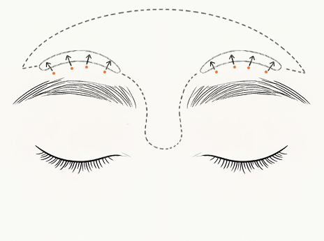 눈썹의 유지인대를 정밀하게 절제하여, 눈썹이 좌우대칭으로[b] 맞추어 줍니다. 또렷한 눈매를 만들고, 오랫동안 이마거상의[m] 효과가[d] 유지되도록 합니다.